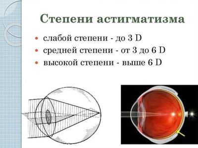 степени астигматизма