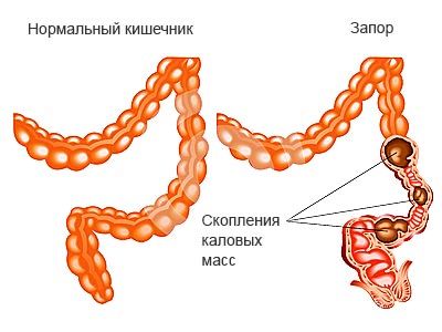 запор в кишечнике