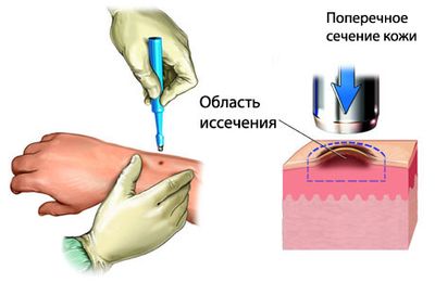 Проведение биопсии