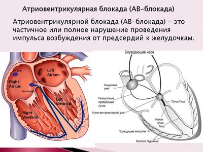 AV-блокада