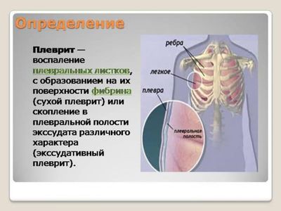opredelenie-plevrita