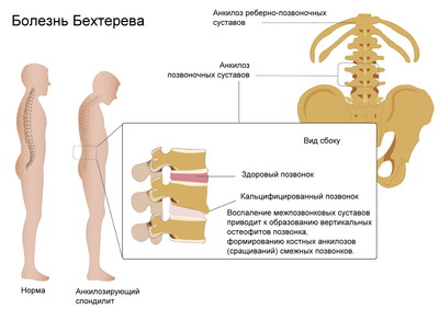 болезнь Бехтерева
