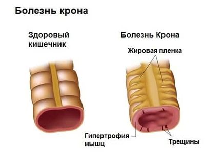 Болезнь Крона
