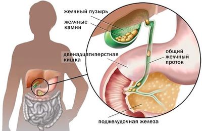 Холецистит