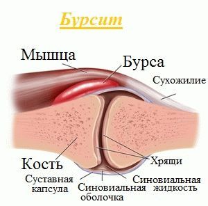 Лечение бурсита медикаментозными и народными средствами