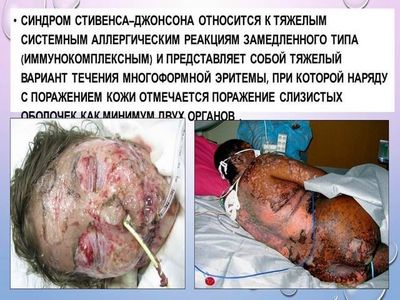 Синдром Стивенса-Джонса