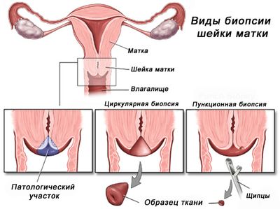 Цервикальная эктопия шейки матки с хроническим цервицитом