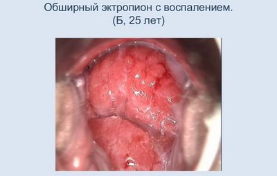 Цервикальная эктопия шейки матки с хроническим цервицитом