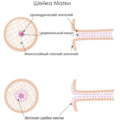 Цервикальная эктопия шейки матки с хроническим цервицитом