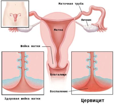 Цервикальная эктопия шейки матки с хроническим цервицитом