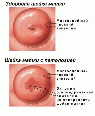 Цервикальная эктопия шейки матки с хроническим цервицитом