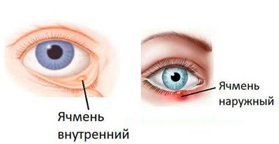 Виды ячменя на глазу