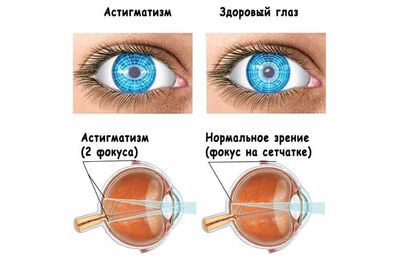 Что такое астигматизм