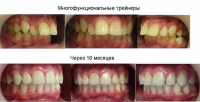 глубокий прикус и его исправление