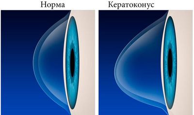 Что такое кератоконус