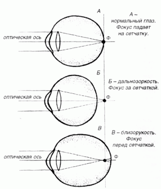фокус при дальнозоркости