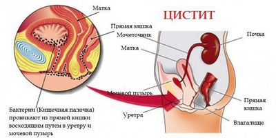 Цистит