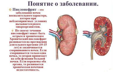 Пиелонефрит