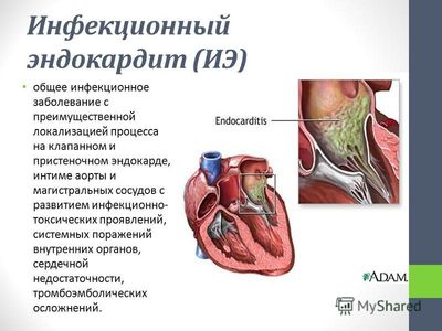 Инфекционный эндокардит