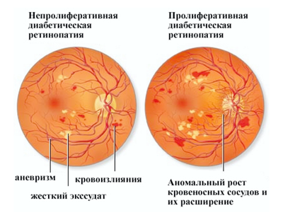 Патология сосудов сетчатки
