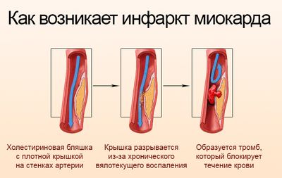 Как возникает ишемия