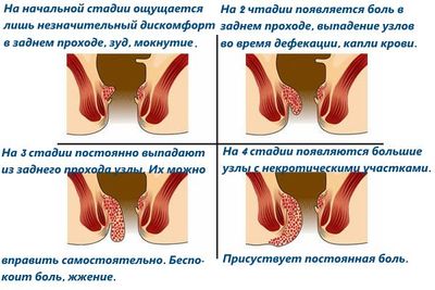 Геморроидальные узлы