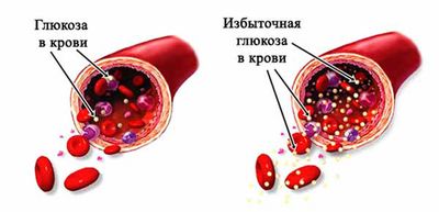 Повышение уровня глюкозы в крови