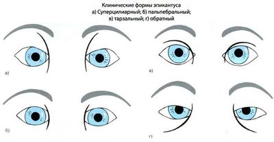 Виды эпикантуса
