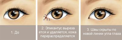 Операция по удалению эпикантуса