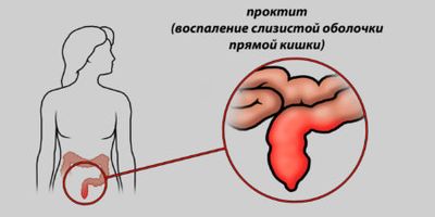 Диагностика и основные правила лечения эрозивного проктита у взрослых