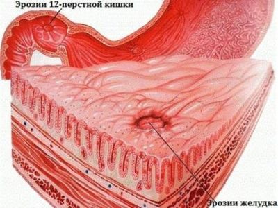 Симптомы заболевания