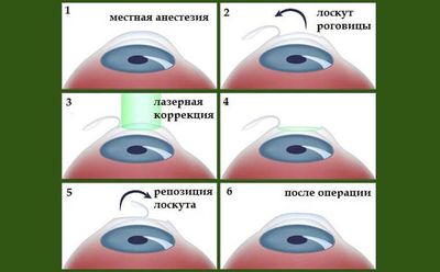 Как проходит лазерная коррекция зрения