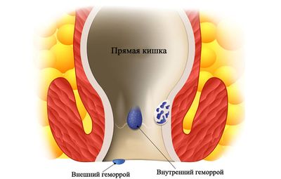 Острый геморрой