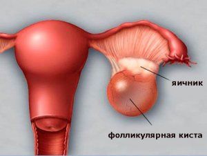 Симптомы зависят от размера кисты