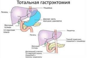 гастринома лечение