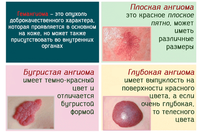 Как выглядит гемангиома