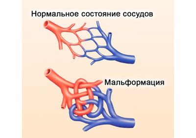 Артериовенозная гемангиома