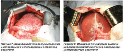 Лапаротомия
