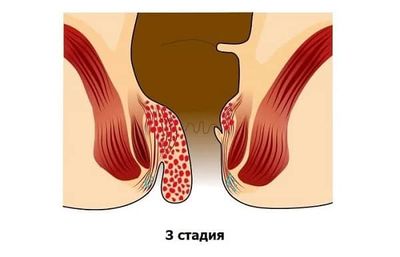 Геморрой 3 степени
