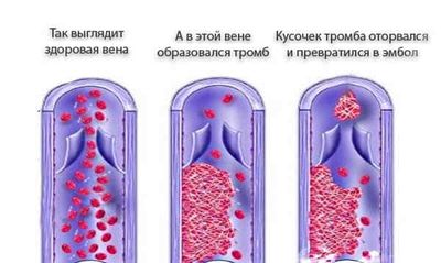 Тромбоз вен