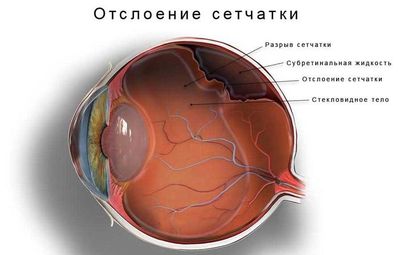 Отслоение сетчатки глаза