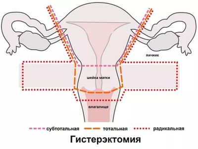 гиперплазия эндометрия лечение после выскабливания