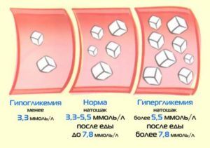 Гипогликемия при сахарном диабете 2 типа - симптомы и профилактика осложнений