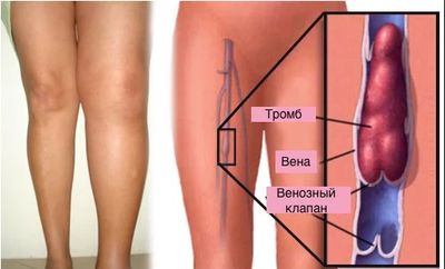 Тромбофлебит при гипотонии
