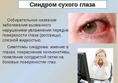Синдром сухого глаза