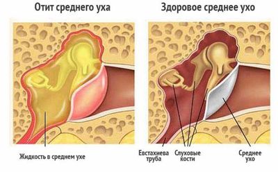 Острый отит