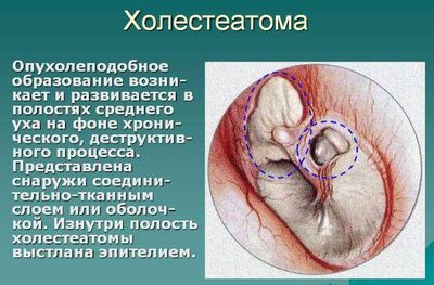 Холестеатома в ухе