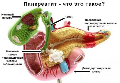 Панкреатит