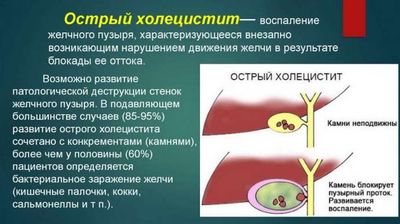 хронический холецистит