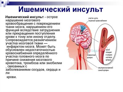 Ишемический инсульт